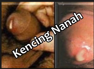 tips cara mengobati kencing nanah