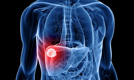 Liver cancer - An overview , types of liver cancer , symptoms of liver cancer....
