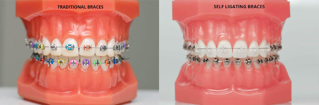 What Is Orthodontic Treatment