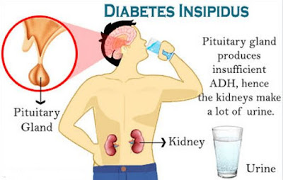 Types of Diabetes Insipidus And Symptoms