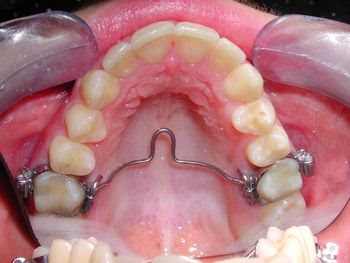 Gumki aparat ortodontyczny