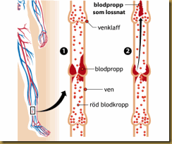 blodpropp
