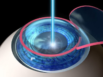 Phương pháp phẫu thuật Lasik có gây tái cận không ?