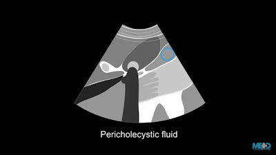 cholecystitis, acalculous cholecystitis, cholecystitis treatment