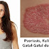 cara menyembuhkan gatal psoriasis