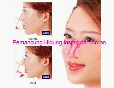 Cara Membedakan Nose Up Asli Dan Palsu alat Pemancung Hidung Asli