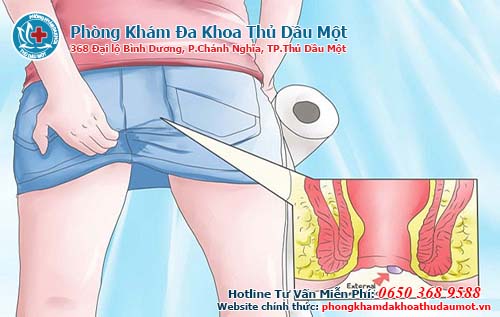 Dấu hiệu của bệnh trĩ ở nữ giới