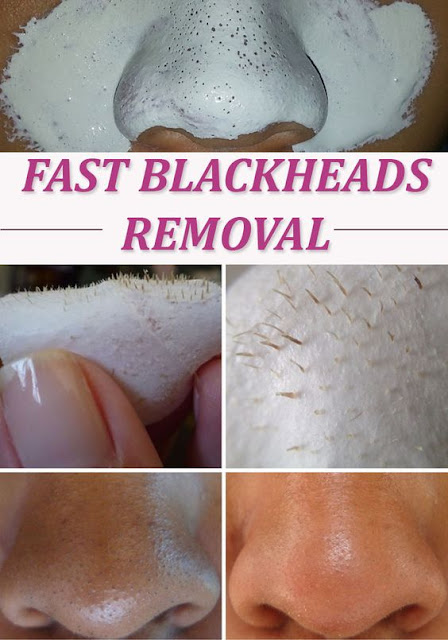 Get Rid of Blackheads in 10 Minutes