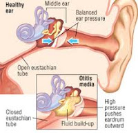 Cara Alami Menyembuhkan Otitis Media Akut