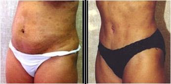 liposuction image