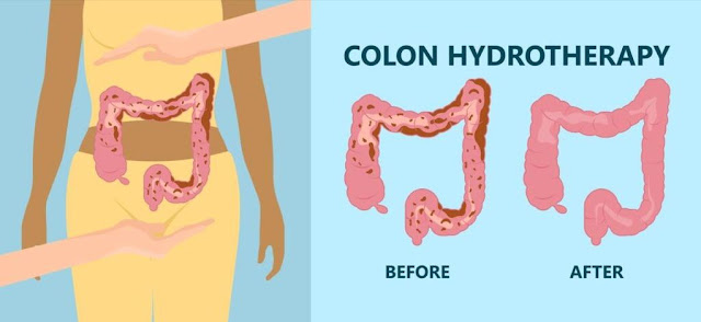 Colon Hydrotherapy