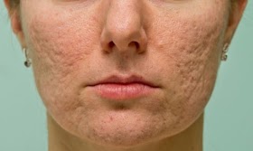 How to Get Rid of Enlarged Pores Naturally