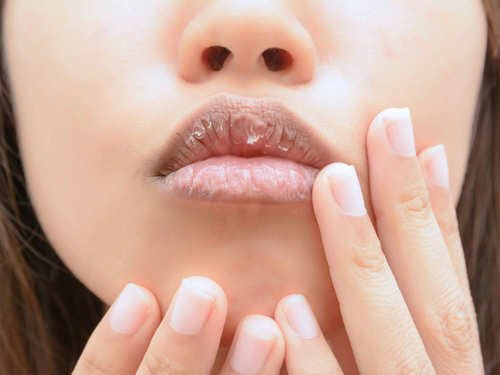 How to treat dry and chapped lips.
