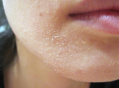 Phân tích triệu chứng da mặt sần sùi và cách khắc phục-1