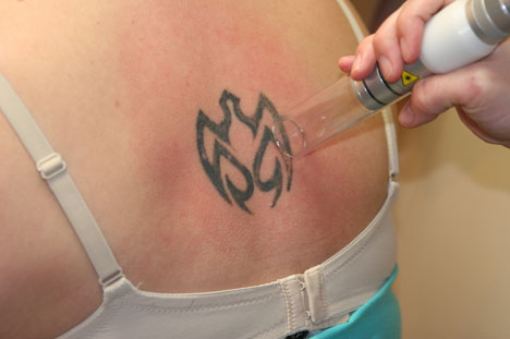 The removal of tattoos involves laser light being absorbed by the skin cells 