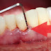  Điều trị viêm chân răng tại nha khoa