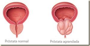 prostatanormal