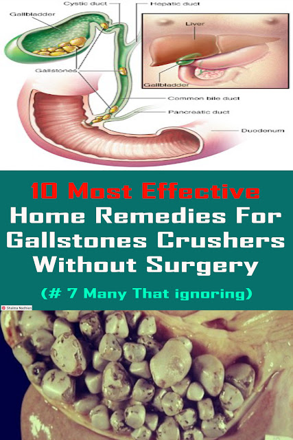 The most effective method to DESTROY AND FLUSH ALL GALLSTONES NATURALLY WITHOUT ANY SURGERY #health #natural #remedies