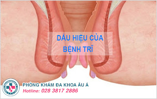 Dấu hiệu của bệnh trĩ