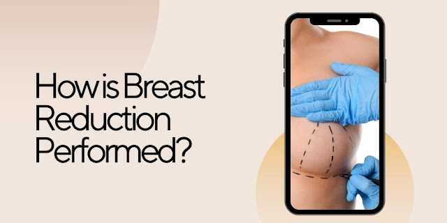 How is Breast Reduction Performed
