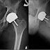 Culpan ortopedas por implantes ‘carabelitas’