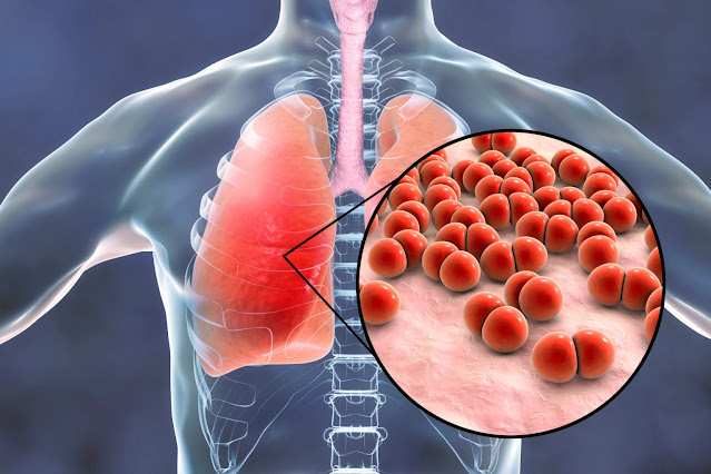 Community-acquired Bacterial Pneumonia (CABP) Treatment Drugs Market