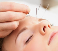 acupuntura y odontologia