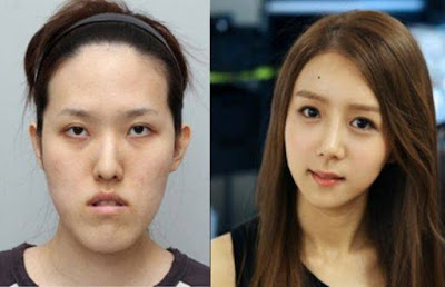 15 Foto 'Before - After' Hasil Operasi Plastik yang Menakjubkan