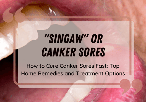singaw-canker-sores