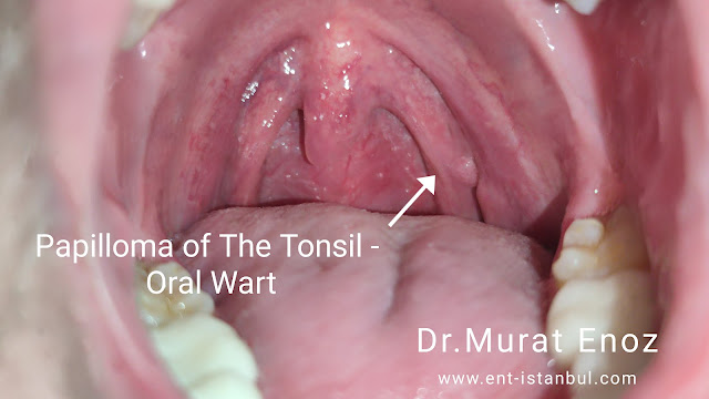 Papilloma of The Tonsil - Oral Wart