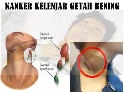 Berapa Biaya Operasi Kelenjar Getah Bening di Leher?