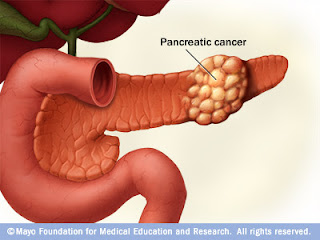 pancreatic cancers, pancreatic cancer survival, what is the treatment for pancreatic cancer, treatment of pancreatic cancer, treatment pancreatic cancer, pancreatic cancer treatment, treatment for pancreatic cancer, survival rate of pancreatic cancer, survival rate pancreatic cancer, survival rate for pancreatic cancer, pancreatic cancer survival rate, pancreas cancer survival rate, survival rates pancreatic cancer, survival rates of pancreatic cancer, survival rates for pancreatic cancer, pancreatic cancer survival rates, causes for pancreatic cancer, what are the causes of pancreatic cancer, causes of pancreatic cancer, pancreatic cancer causes of, pancreatic cancer causes, what causes pancreatic cancer, causes pancreatic cancer, pancreatic cancer cause, the cause of pancreatic cancer, what cause pancreatic cancer, cause pancreatic cancer, cause of pancreatic cancer, stage 4 pancreatic cancer, pancreatic cancer stage 4, prognosis for pancreatic cancer, prognosis of pancreatic cancer, pancreatic cancer prognosis, prognosis pancreatic cancer, what is the prognosis of pancreatic cancer