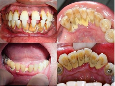 Tác hại của vôi răng tới răng miệng