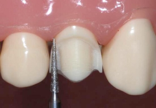 Mài cùi răng là chỉ định bắt buộc khi bọc răng sứ