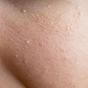 how to get rid of tiny bumps on face quickly