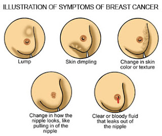 Cara mengobati kanker di payudara secara tradisional 