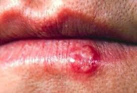 herpes cold sores fever blisters