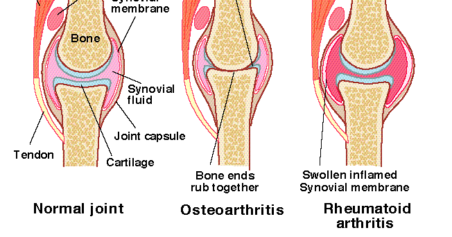 Penyakit Arthritis - Gel Lutut