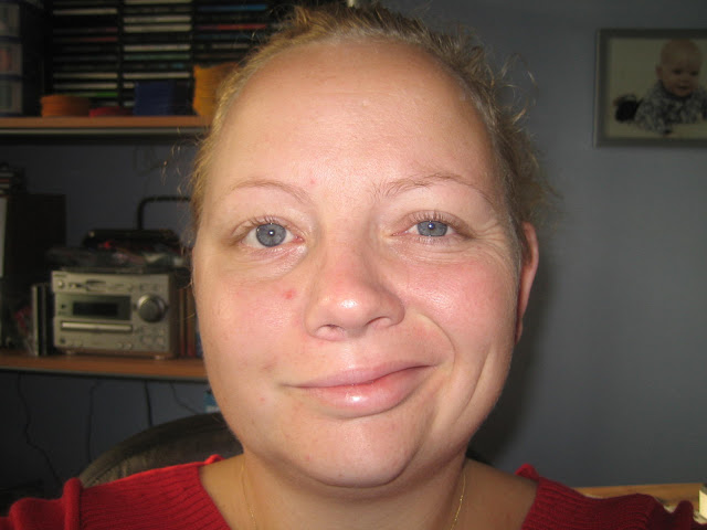 30 year old woman with bells palsy for 3 months