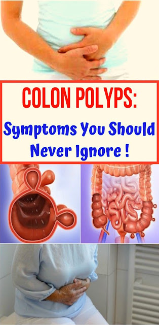 Colon Polyps: Symptoms You Should Never Ignore