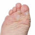 Corns and Calluses Causes, Treatment and Home Remedies