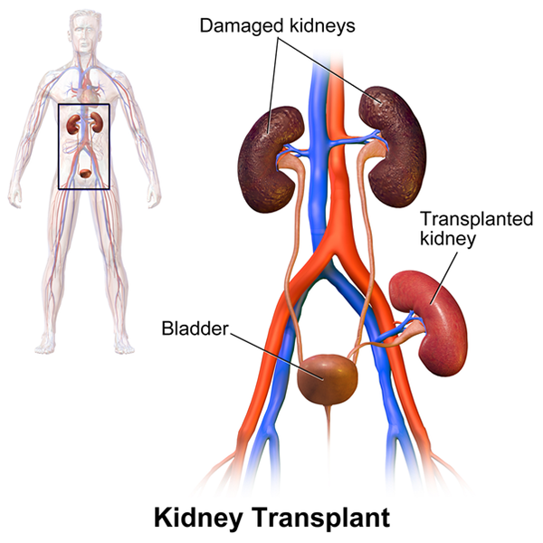 best kidney transplant doctor in India
