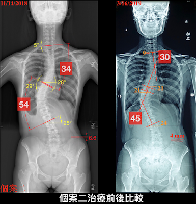 脊椎側彎, 脊椎側彎 矯正, 脊椎側彎治療 , 脊椎側彎度數進步