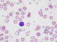 Peripheral blood smear microscopy of a patient with iron-deficiency anemia.