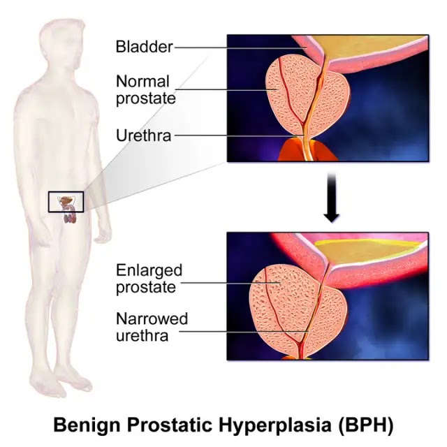 BPH Full Form in Medical in Hindi