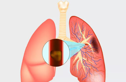 Embolia pulmonar: entenda como prevenir a condição relacionada à trombose que pode causar morte súbita