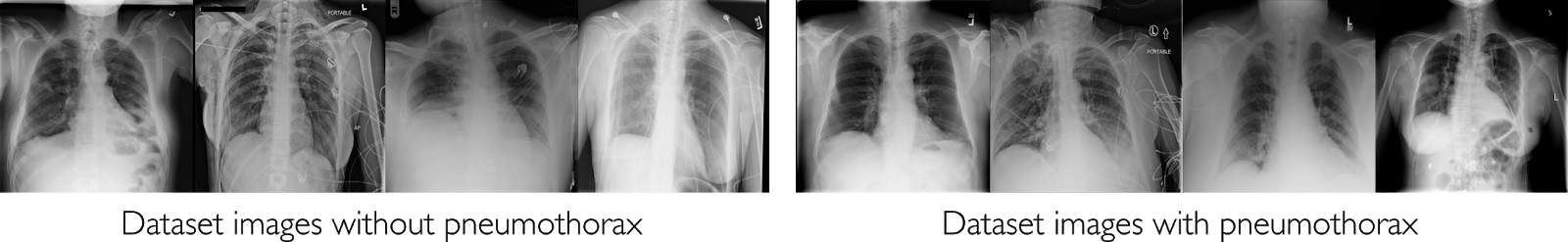 dataset images with and without pneumothorax
