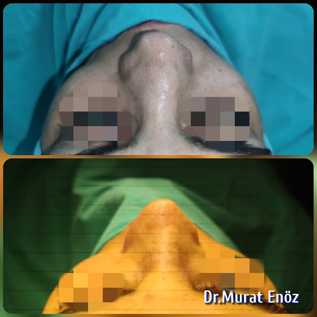 Micromotor Assisted Revision Nose Aesthetic Surgery, Complicated Revision Rhinoplasty, Open roof deformity,Nasal valve collapse,Crooked nose,