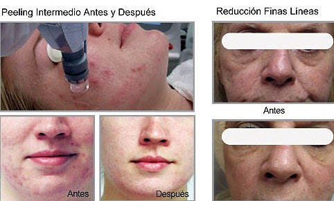 Resultado de imagen para Pulido láser para el acne