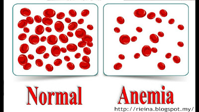 Cara Atasi Anemia Pada Ibu Hamil